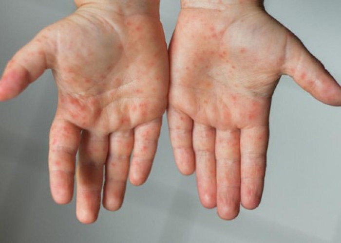 Dinkes Cianjur Minta Masyarakat Waspadai Penyebaran Virus Campak