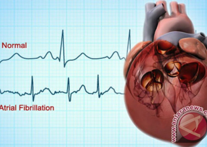Dokter: Skrining untuk Deteksi Risiko Kelainan Jantung Saat Olahraga 