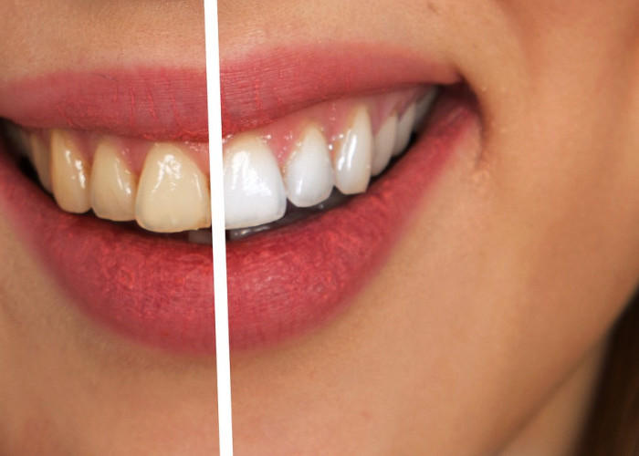 Buat Gigi Putih Cemerlang, dengan 6 Langkah Sederhana Berikut!