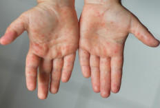 Dinkes Cianjur Minta Masyarakat Waspadai Penyebaran Virus Campak